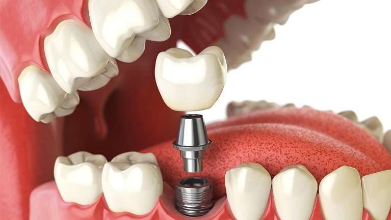 3D illustration of a dental implant with crown, abutment, and titanium post showing how implants res