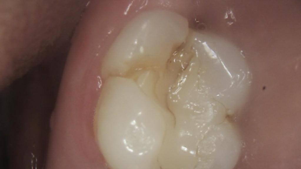 What If I Notice Cracks in My Teeth? Other Highgate Hill QLD